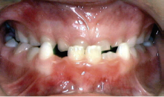 Problems To Look For At Age 7 8 Anterior Crossbite Underbite