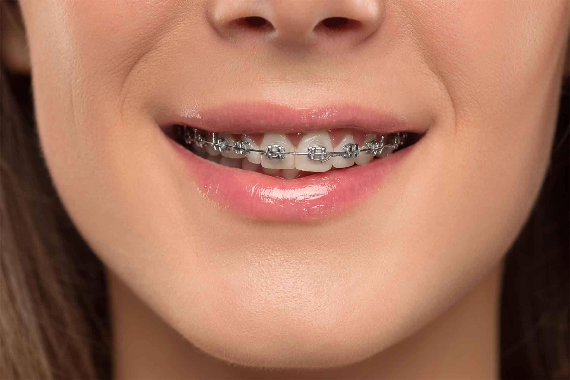 Beautiful young woman with teeth braces