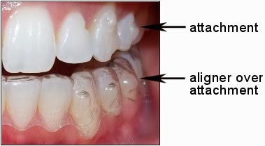 ATTACHMENTS In Clear Aligner