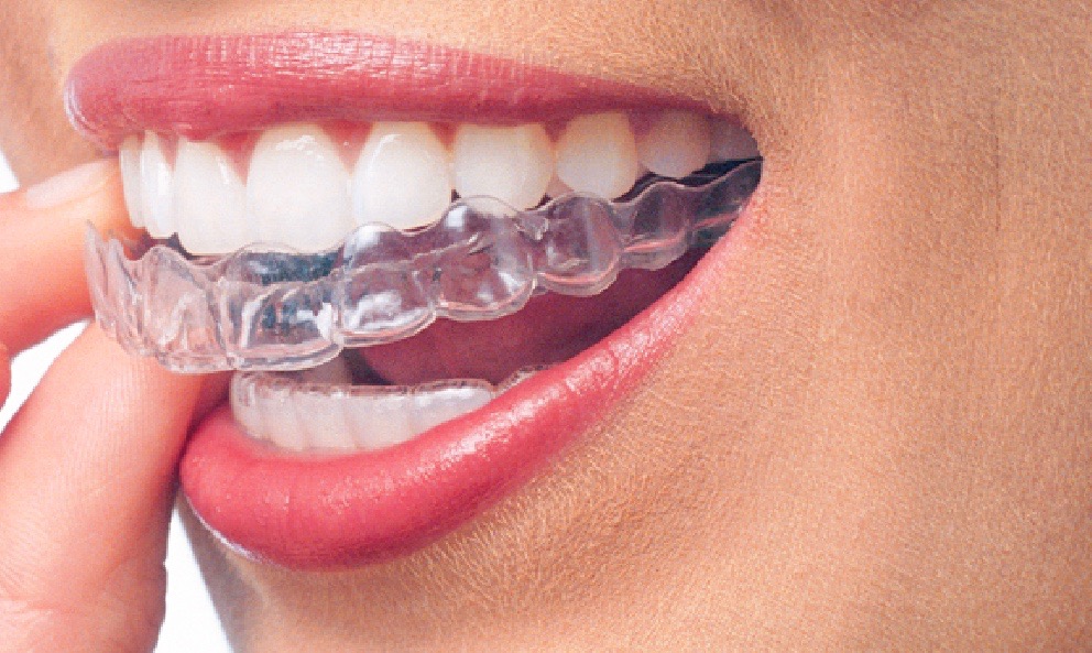 Clear aligners